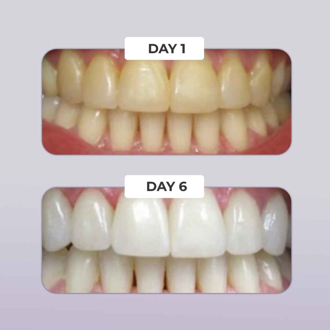 PuurWhite™ Teeth Whitening Kit with LED Light