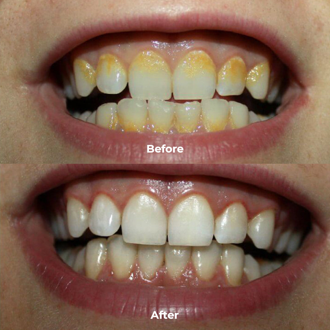 PUURSMILE WATER FLOSSER - 50% OFF HALLOWEEN SALE + 3 FREE GIFTS (WORTH $120)