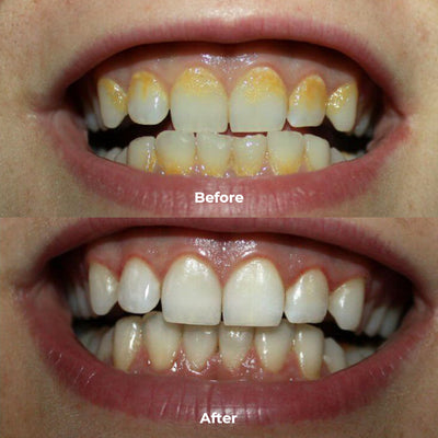 PUURSMILE WATER FLOSSER - 50% OFF HALLOWEEN SALE + 3 FREE GIFTS (WORTH $120)