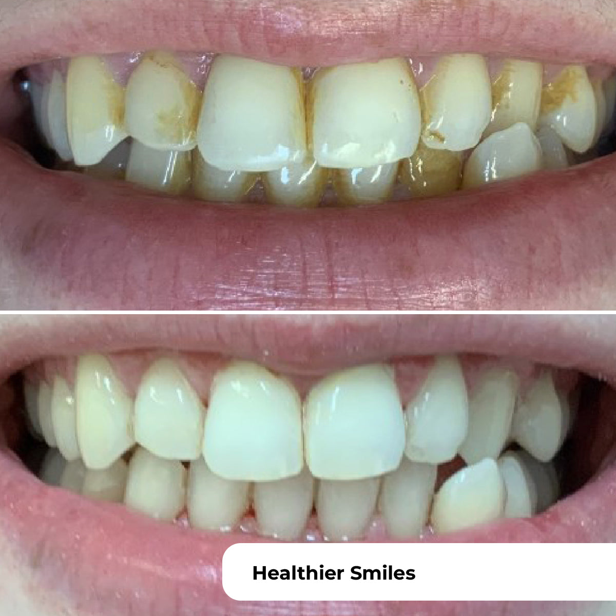 PUURSMILE WATER FLOSSER - 50% OFF HALLOWEEN SALE