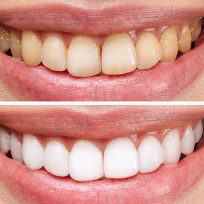 Teeth Whitening Kit (Preview Only)